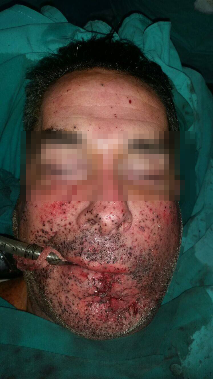 Una bomba de estruendo le destruyó la cara en Navidad: se la reconstruyeron en un hospital de la Provincia